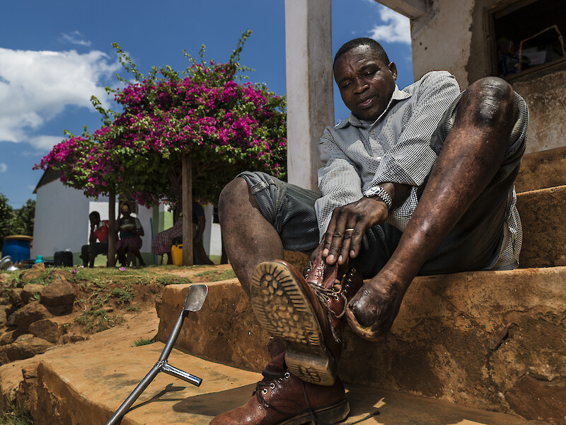 Long Limbs Prosthetics