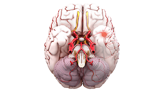 Bottom view of the brain for localising the aneurysm.
